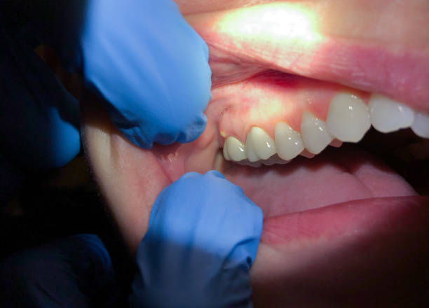 Best Broken or Cracked Tooth Emergency Dentist in Bainbridge Island, WA