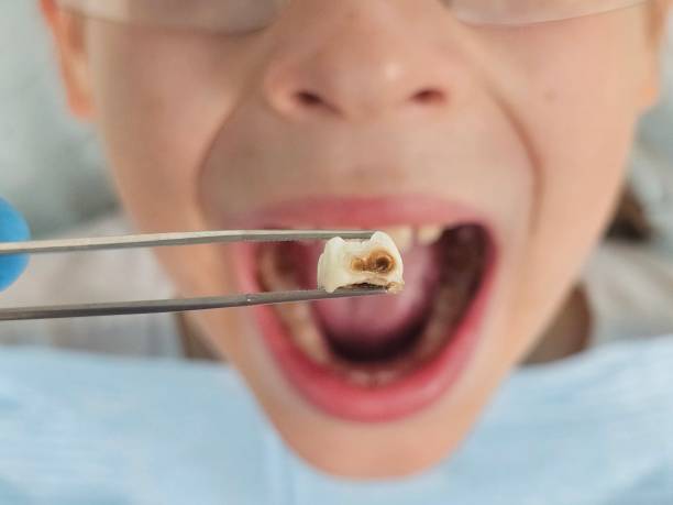 Best Emergency Dental Care for Abscessed Tooth in Bainbridge Island, WA